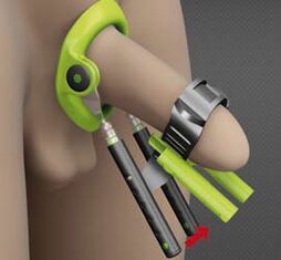 Rehabilitación despois dunha operación para aumentar o pene