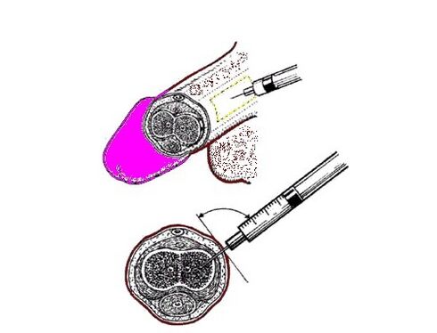 Bombear vaselina no pene para aumentar